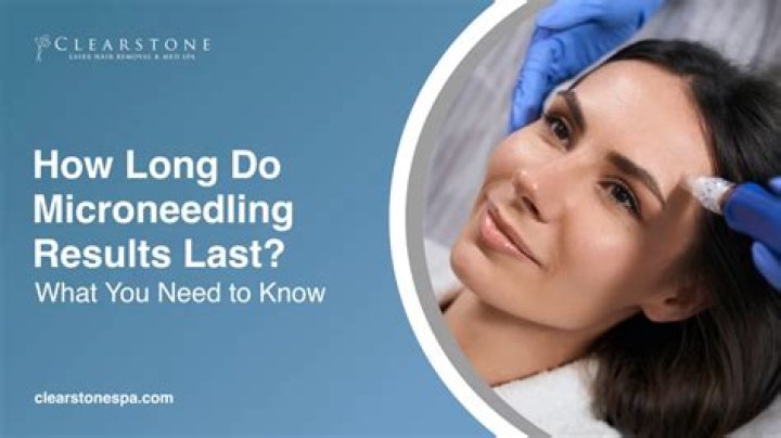How long does microneedling last on your face?
