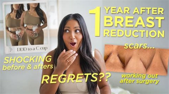 How long is the recovery for breast reduction?