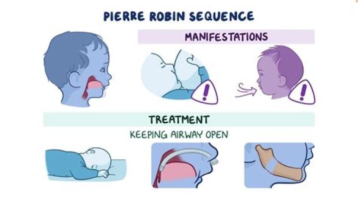 How many babies are born with Pierre Robin sequence?