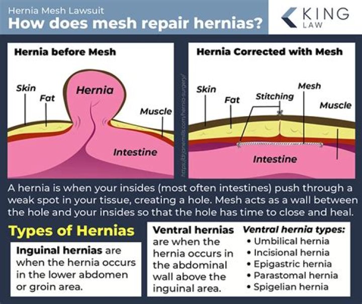How many years does hernia mesh last?