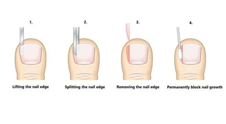 How much does it cost to remove a toenail?