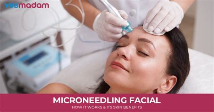 How much is microneedling for dark spots?