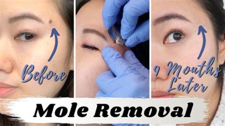 How much is mole removal?
