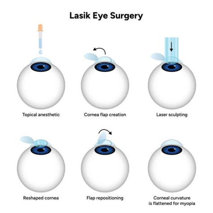 How often does LASIK go wrong?