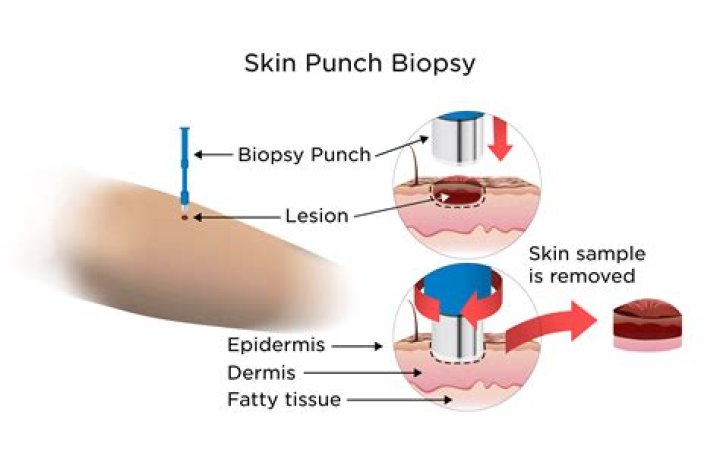 How painful is a skin biopsy?