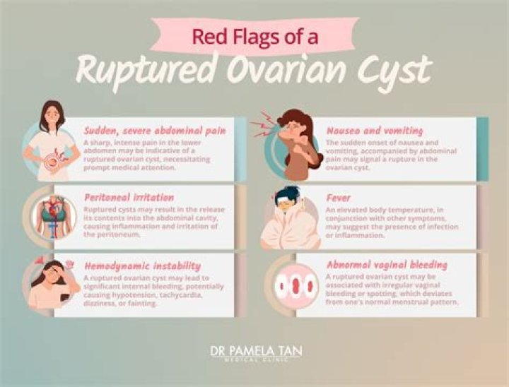 How painful is an ovarian cyst rupture?