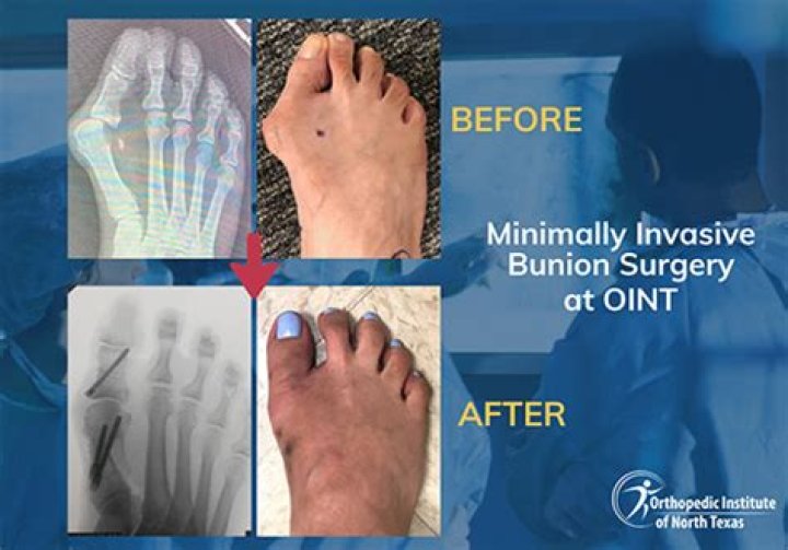 How painful is bunion surgery?