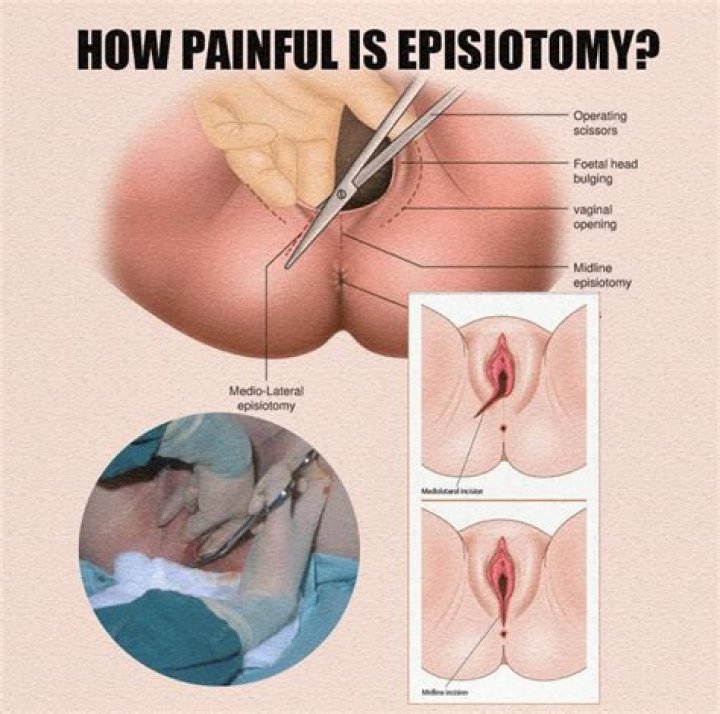 How painful is episiotomy?
