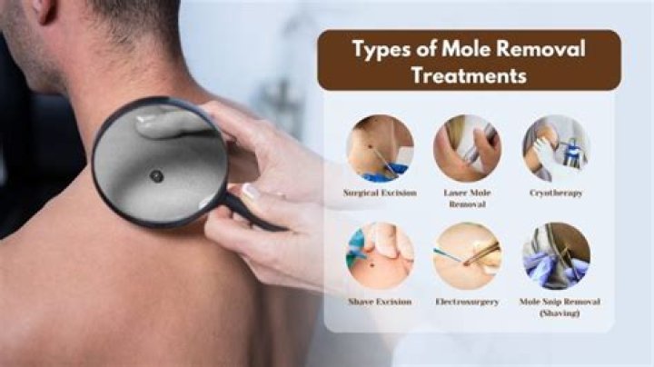 How painful is mole removal?