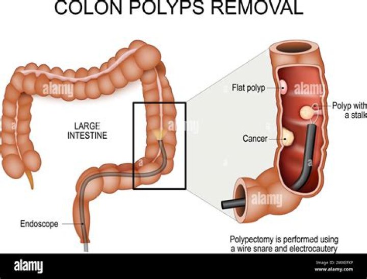 How quickly do colon polyps grow?