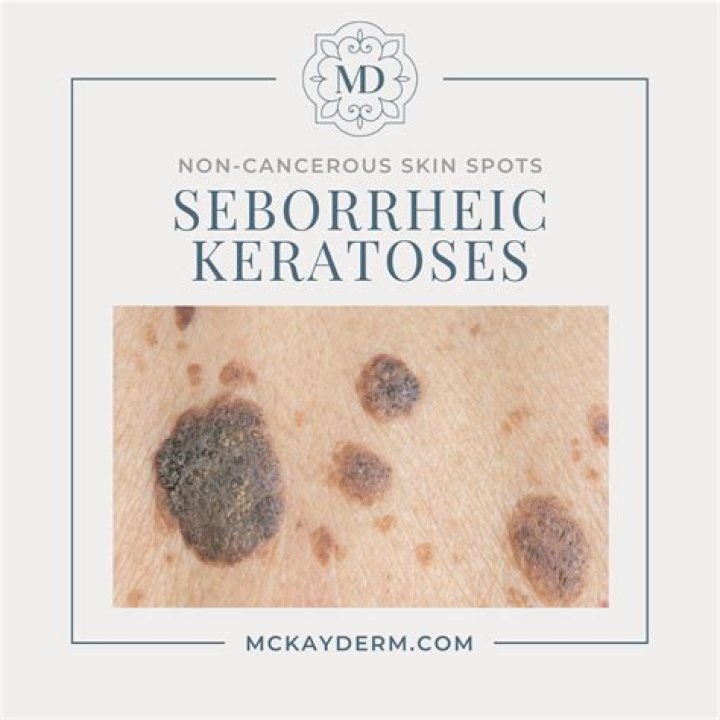 How serious is a cancerous mole?