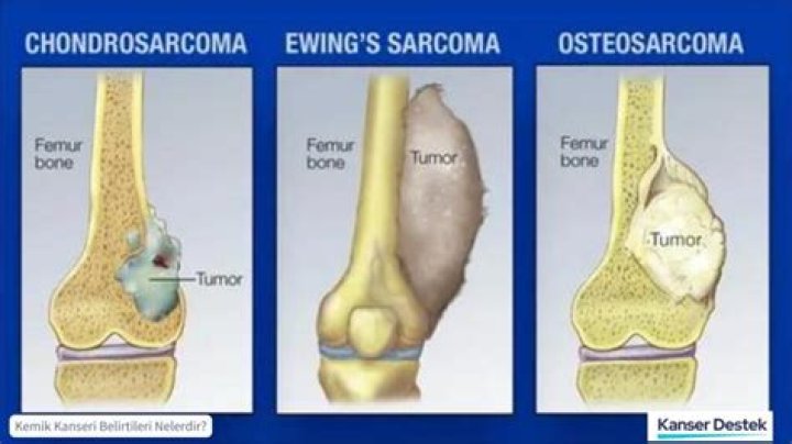How serious is a sarcoma?