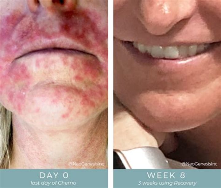 How soon do chemo side effects start?