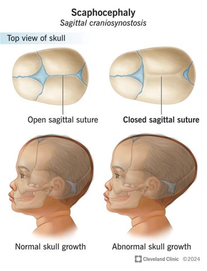 How successful is craniosynostosis surgery?