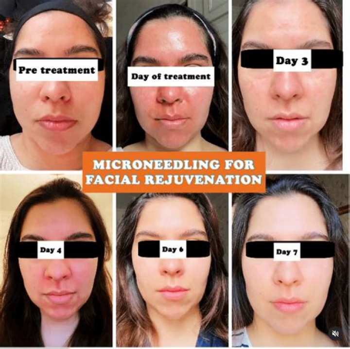 How will my face look after microneedling?