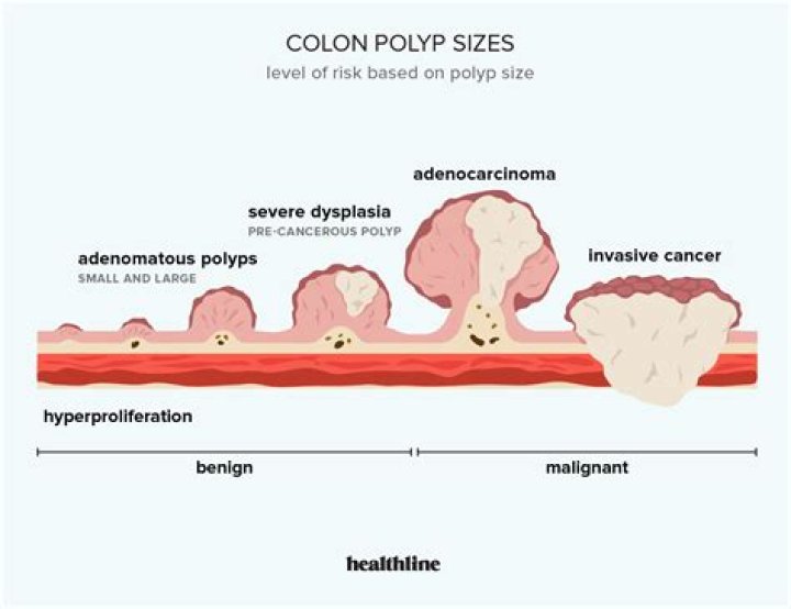 Is a 10 mm polyp large?