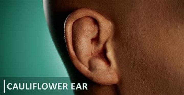 Is a cauliflower ear permanent?