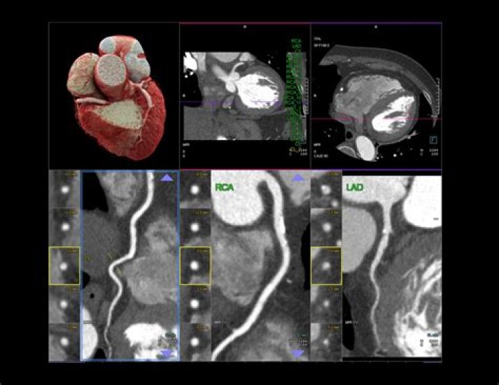 Is a heart CT scan worth it?