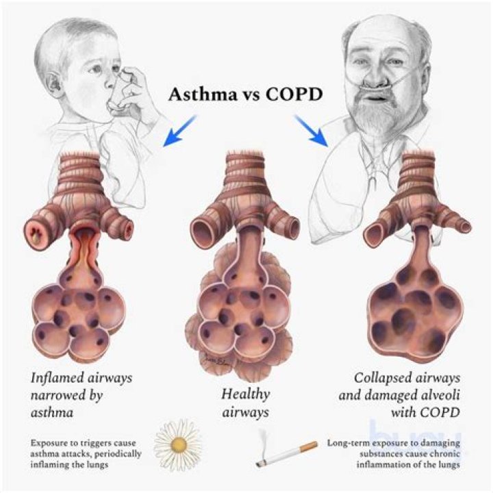 Is asthma a COPD?