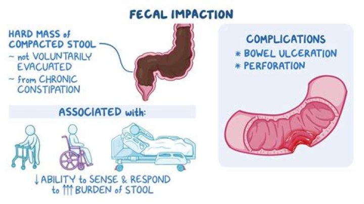 Is bowel obstruction and fecal impaction the same thing?
