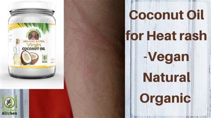 Is coconut oil good for heat rash?