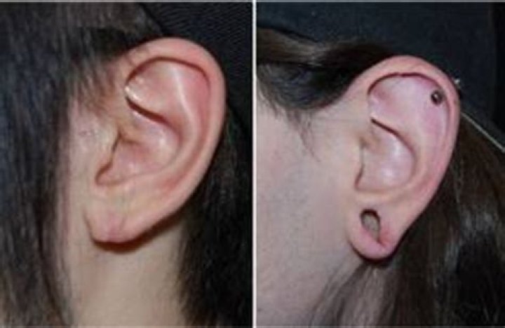 Is ear stretching permanent?