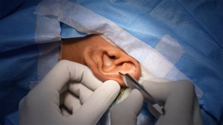 Is Earfold permanent?