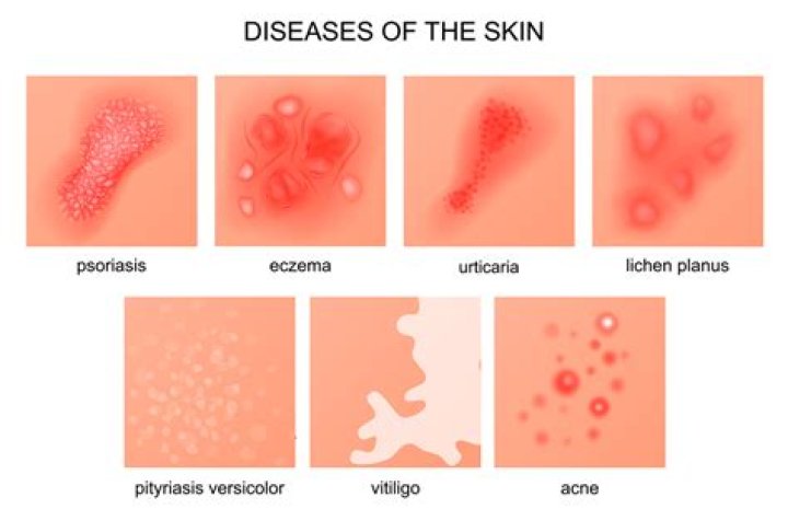 Is eczema a gut problem?