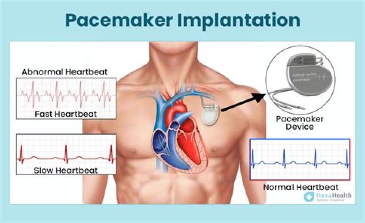 Is getting a pacemaker a big deal?