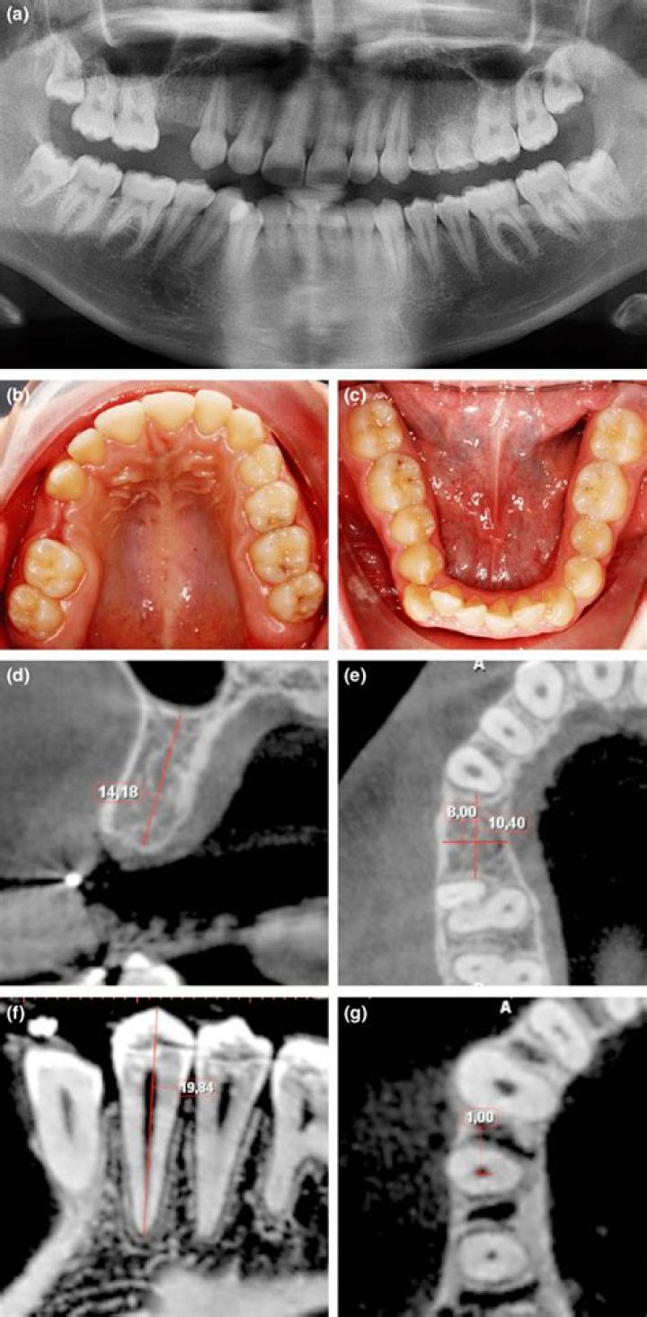 Is hypodontia genetic?