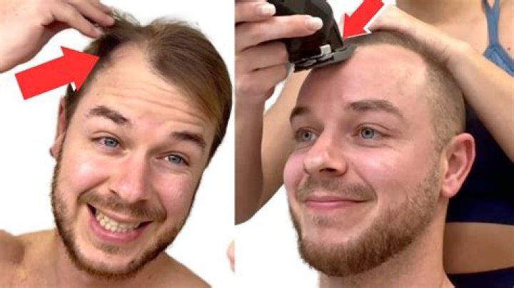 Is it better to shave head when balding?
