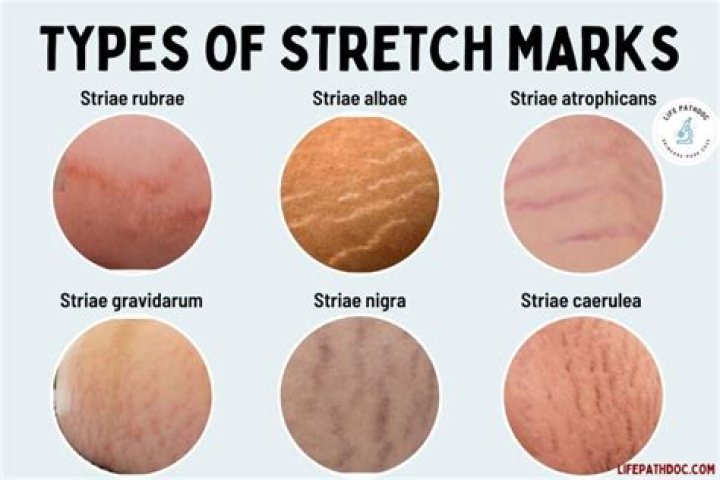Is it normal for a 9 year old to have stretch marks?