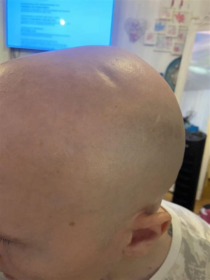 Is it normal to have a dent in your head after brain surgery?