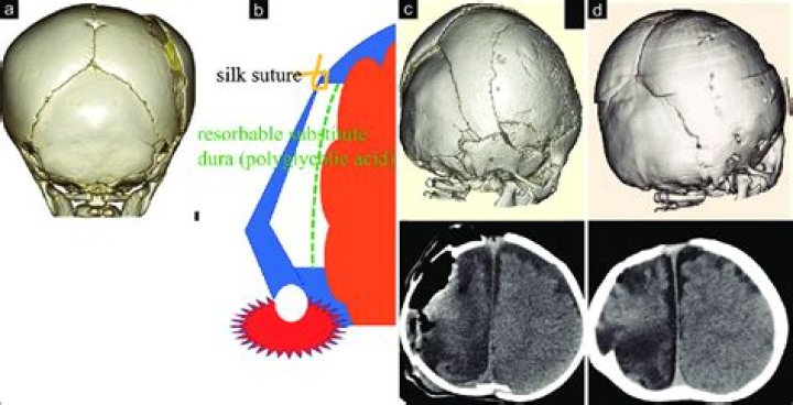Is it normal to have seizures after a craniotomy?