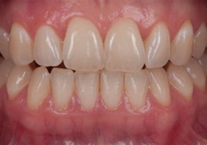 Is it normal to see your teeth through your gums?