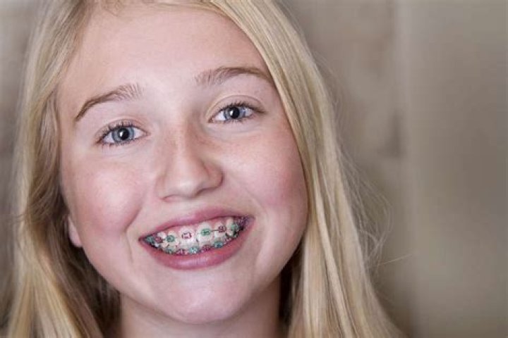 Is it OK for a 9 year old to get braces?