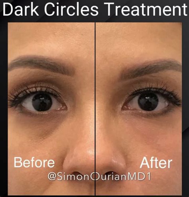 Is it possible to get rid of dark circles?