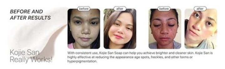 Is Kojie San effective for dark spots?