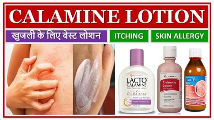 Is lotion good for acne?