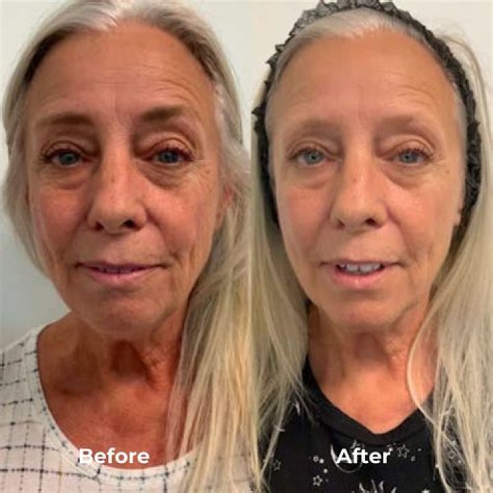 Is microneedling good for 60 year olds?