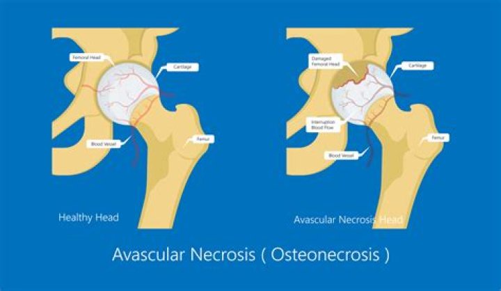 Is osteonecrosis a disability?