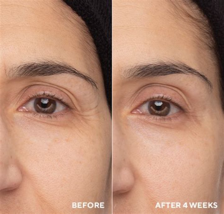 Is retinol good for dark circles?
