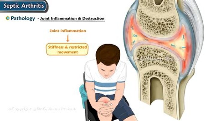 Is rice OK for arthritis?
