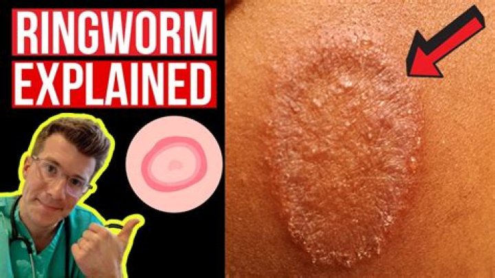 Is ringworm harmful to humans?