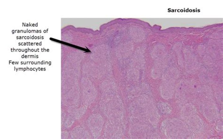Is sarcoidosis a granulomatous disease?