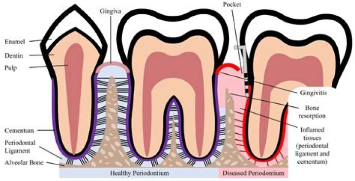 Is Sensodyne Good for periodontal disease?