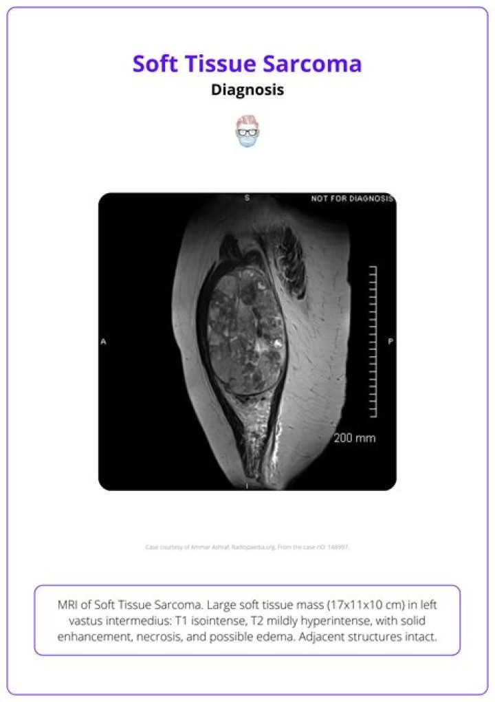 Is soft tissue sarcoma hard or soft?