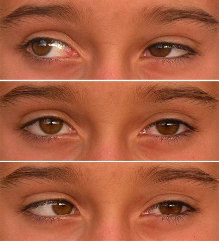 Is strabismus a genetic disorder?