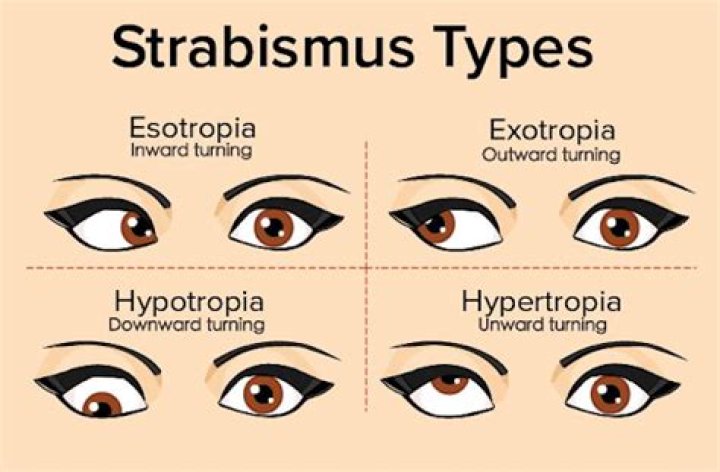 Is strabismus genetic?