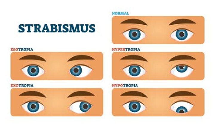 Is strabismus same as lazy eye?